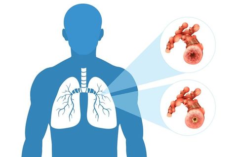 A Complete COPD Treatment Guide: Facts, Insights, and Helpful Resourcess