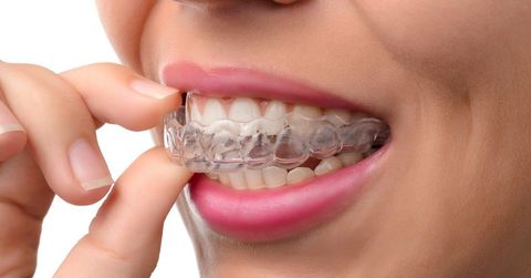 Invisalign Treatment Duration Explained: A Complete Guide for Beginners