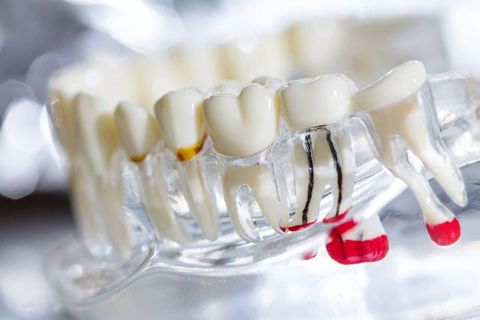 Discover Root Canal Treatment: Overview, Explanation, Tips, and Essential Knowledge