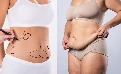Explore the Basics of Liposuction for Belly Fat: A Complete Guide